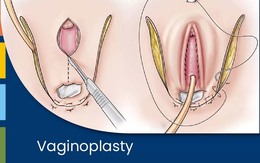 Vaginoplasty Procedure