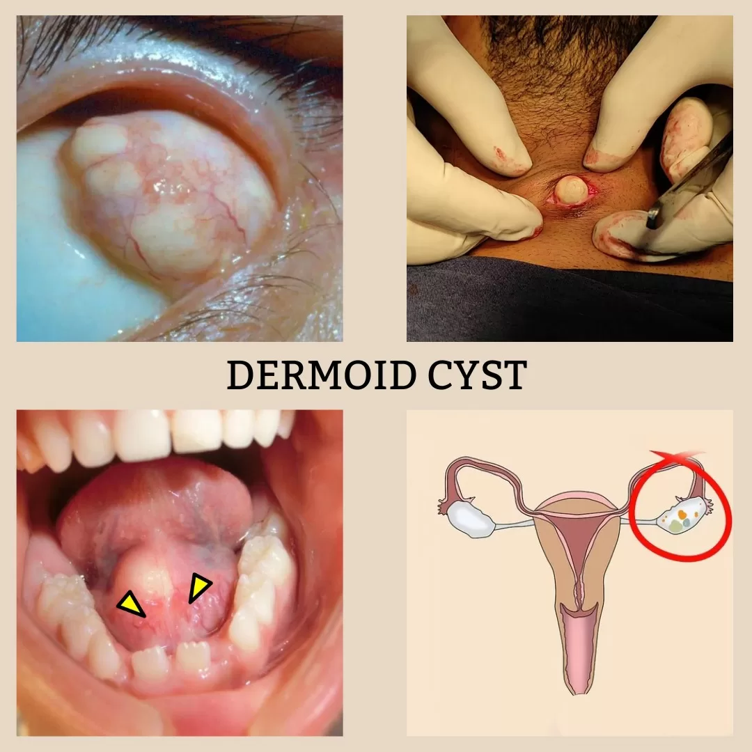 Dermoid Cyst - Orkid Medilife Hospital